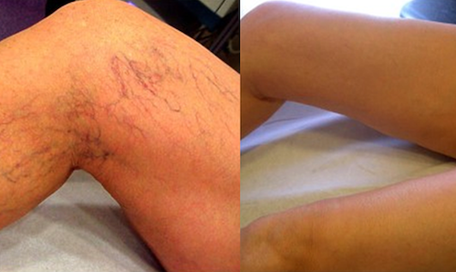 sclerotherapy spider vein removal before after results